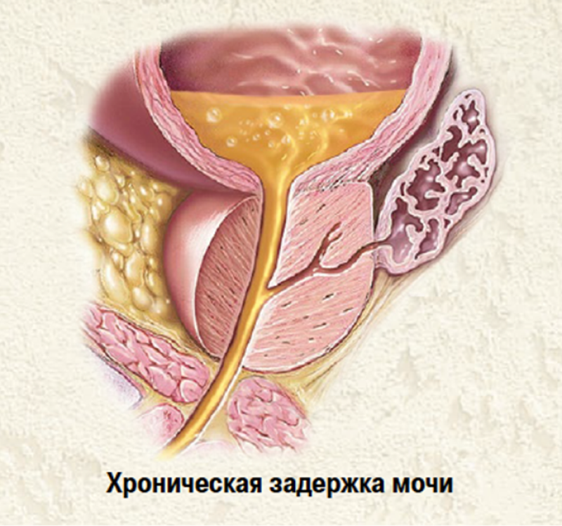 б
