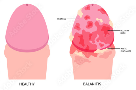Баланопостит